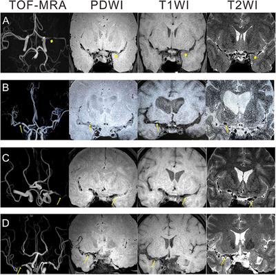 Association Between Plasma Lipoprotein-Associated Phospholipase A2 and Plaque Vulnerability in TIA Patients With Unilateral Middle Cerebral Artery Stenosis